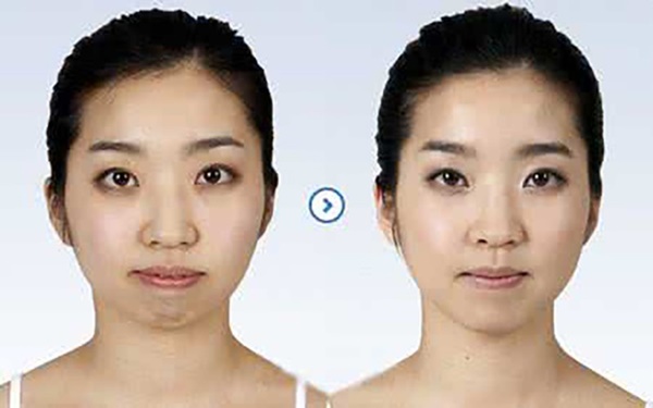 Làm đẹp bằng cách tiêm mỡ tự thân sẽ không trở thành nỗi ác mộng kinh hoàng nếu bạn nhớ 5 điều quan trọng này từ chuyên gia-2