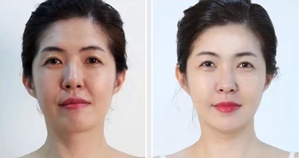 Làm đẹp bằng cách tiêm mỡ tự thân sẽ không trở thành nỗi ác mộng kinh hoàng nếu bạn nhớ 5 điều quan trọng này từ chuyên gia-3