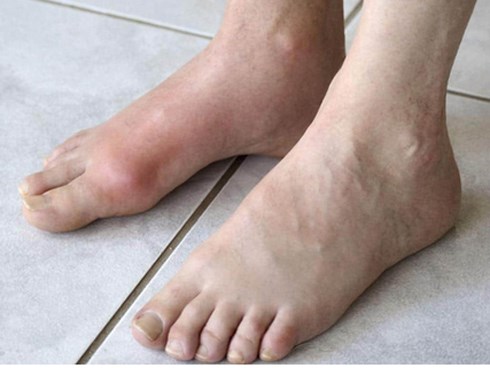 Cậu bé 13 tuổi mắc bệnh gout, nguyên nhân đến từ thức uống mà hầu hết đứa trẻ nào cũng ưa thích
