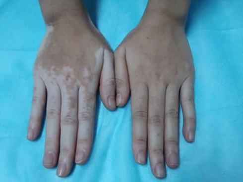 Kỳ lạ cô gái bỗng nhiên đổi màu tay chân vì chữa ra mồ hôi bằng lá trầu không