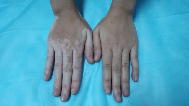 Kỳ lạ cô gái bỗng nhiên đổi màu tay chân vì chữa ra mồ hôi bằng lá trầu không-1