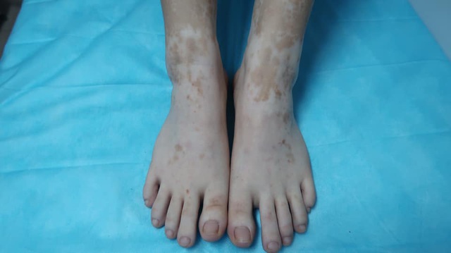 Kỳ lạ cô gái bỗng nhiên đổi màu tay chân vì chữa ra mồ hôi bằng lá trầu không-2