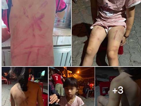 Xôn xao việc bà cố đánh cháu gái 6 tuổi bầm tím người ở Quảng Nam