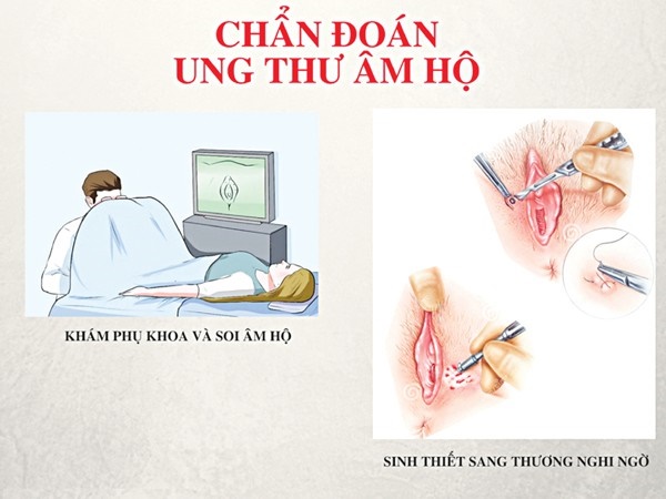 Tưởng chỉ là sợi lông mọc ngược vô hại ở vùng kín, ai ngờ lại là dấu hiệu của bệnh ung thư hiếm gặp-5