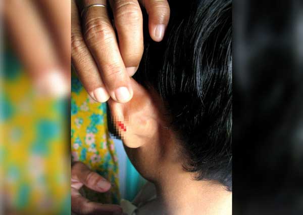 Không làm bài tập về nhà, học sinh bị thầy giáo phạt bằng cách dập ghim vào tai-1