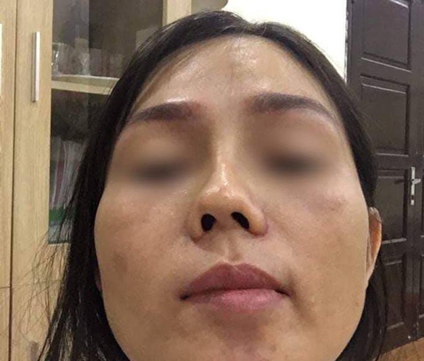 Có thể tự nâng mũi hay không: Chuyên gia đưa ra giải đáp khiến ai cũng kinh ngạc-3