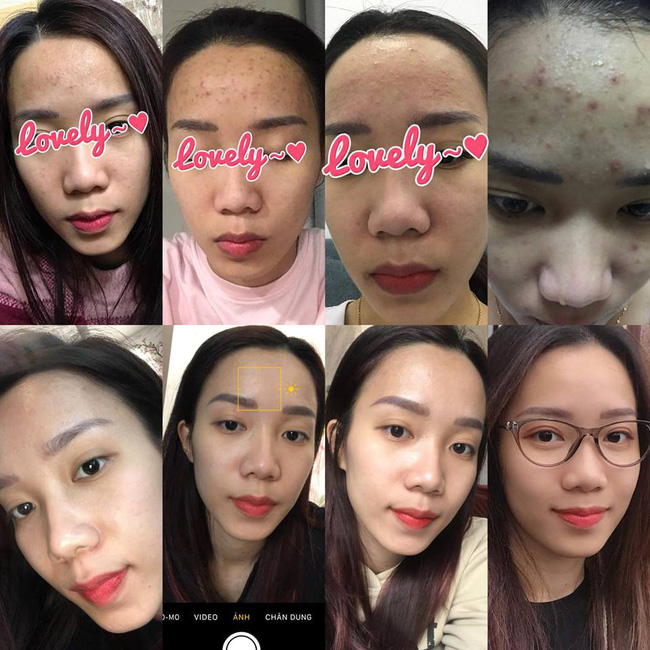 1 năm bị mụn chi chít, 3 tháng sau da mặt cô nàng này láng căng nhờ cách chăm sóc cực đơn giản-1