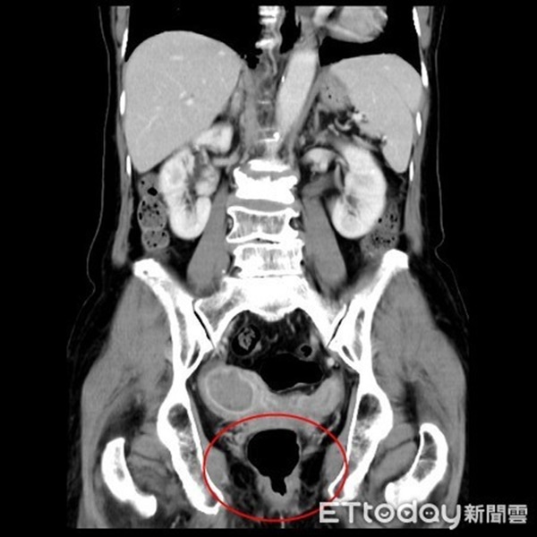 Mãn kinh 20 năm bỗng có kinh nguyệt trở lại, đi khám phụ khoa bác sĩ tiết lộ bất ngờ và điều bất cứ chị em nào cũng nên chú ý-2