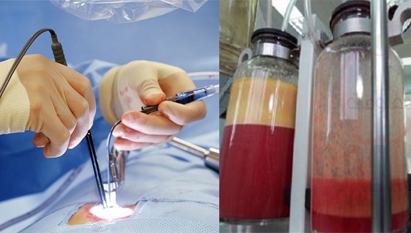 Cận cảnh dùng ống hút mỡ xiên bụng khách bị bóc phốt như chọc tiết lợn: Bác sĩ chuyên khoa cũng phải thảng thốt hút mỡ bụng đáng sợ như vậy sao?-4