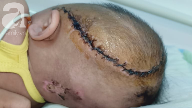 Vụ bé gái 8 tháng tuổi nghi xuất huyết não ngay ngày đầu đi nhà trẻ: Giám định bé bị thương tật đến 84%-1