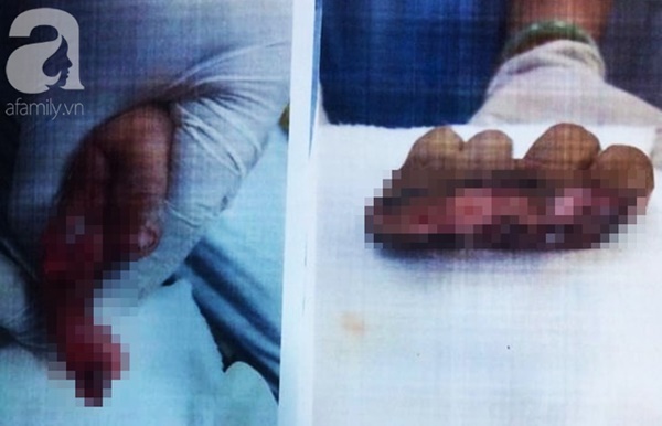 Tai nạn kinh hoàng: Người nhà thử xe máy mới mua, bé trai 1 tuổi bị đứt lìa 4 ngón tay-1