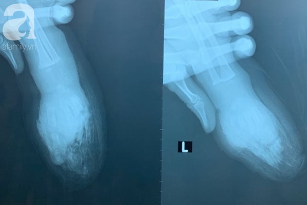 Tai nạn kinh hoàng: Người nhà thử xe máy mới mua, bé trai 1 tuổi bị đứt lìa 4 ngón tay-2