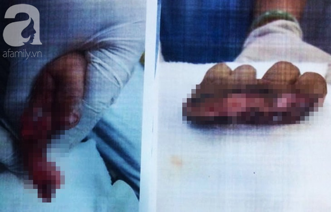 Người nhà thử xe máy mới mua, bé trai 1 tuổi bị đứt lìa 4 ngón tay-1