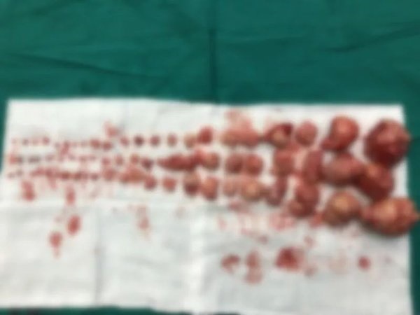 Nữ bệnh nhân có 68 khối u xơ tử cung, có dấu hiệu này khi kinh nguyệt nên khám ngay-1