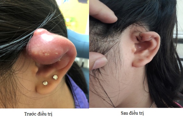 Từ trường hợp bé gái 12 tuổi bị áp xe tai, tụ mủ do xỏ khuyên tai, cha mẹ đừng làm ngơ với lời khuyên này của bác sĩ-1