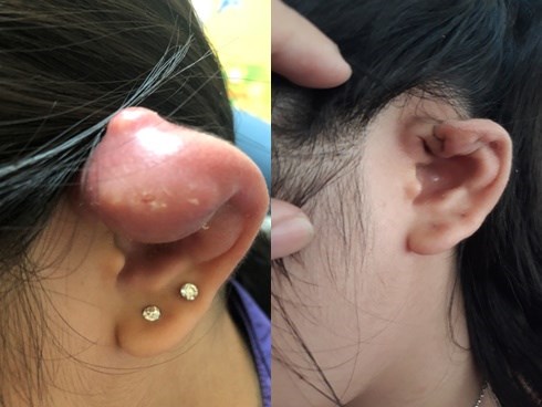 Từ trường hợp bé gái 12 tuổi bị áp xe tai, tụ mủ do xỏ khuyên tai, cha mẹ đừng làm ngơ với lời khuyên này của bác sĩ