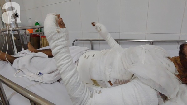 Bị vợ đuổi khỏi nhà, người chồng 23 tuổi quẫn trí mua xăng về tự thiêu khiến cơ thể bỏng nặng-4