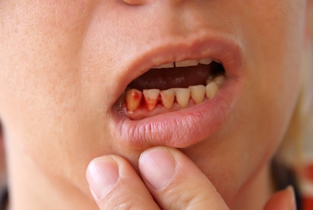 Người đàn ông bị nhiễm uốn ván sau khi xỉa răng: Hành động nhỏ nhưng rất nhiều người mắc-3