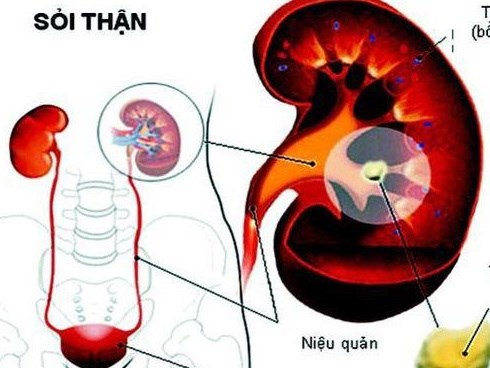 8 thói quen nên bỏ ngay trước khi cơ thể kết đầy sỏi ở thận hay mật