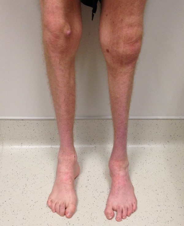 Đế chế Samsung và căn bệnh di truyền đáng sợ mang tên teo cơ MÁC, thừa mứa” tiền quyền cũng không thể chữa khỏi-9