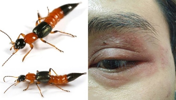 Kiến ba khoang tấn công, độc tố mạnh gấp 12-15 lần rắn hổ mang: Đây là cách xử lý ĐÚNG NHẤT bác sĩ khuyên làm-2