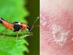 Độc tố của kiến ba khoang mạnh gấp 12-15 lần rắn hổ mang: Nhận biết kiến ba khoang và phòng tránh chất độc của chúng dính vào da-7