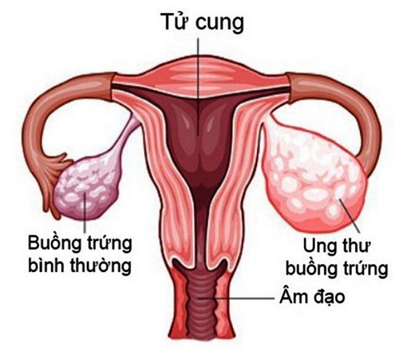 Nhiều trẻ chưa 15 tuổi đã mắc ung thư buồng trứng, đừng chủ quan khi thấy dấu hiệu này-1