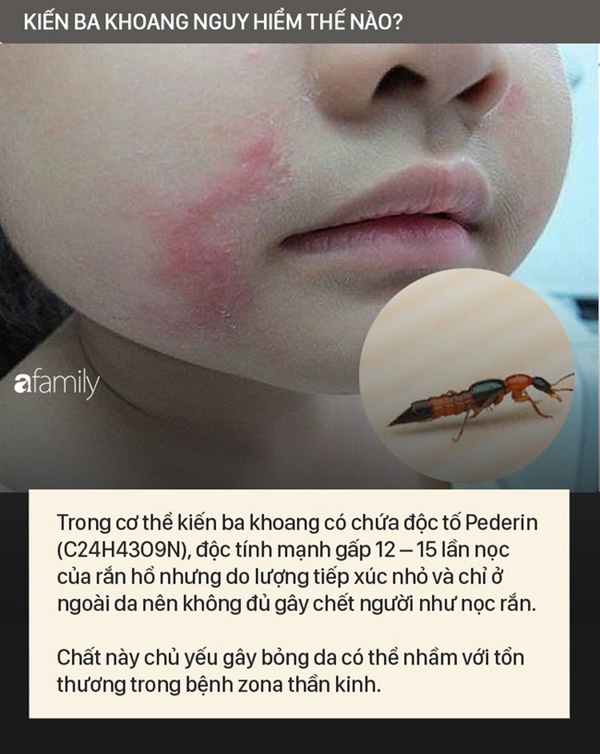 Độc tố của kiến ba khoang mạnh gấp 12-15 lần rắn hổ mang: Nhận biết kiến ba khoang và phòng tránh chất độc của chúng dính vào da-3