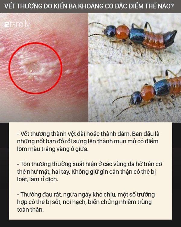 Độc tố của kiến ba khoang mạnh gấp 12-15 lần rắn hổ mang: Nhận biết kiến ba khoang và phòng tránh chất độc của chúng dính vào da-4