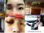 Vụ cô gái bị mù vĩnh viễn sau khi nâng mũi: Cơ sở làm đẹp từng bị yêu cầu dừng hoạt động 2 lần nhưng vẫn làm liều-4