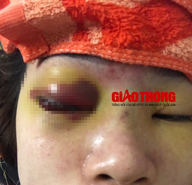 Bắc Giang: Nâng mũi tại cơ sở làm đẹp, cô gái bị mù vĩnh viễn-2