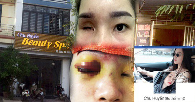 Bắc Giang: Nâng mũi tại cơ sở làm đẹp, cô gái bị mù vĩnh viễn-1