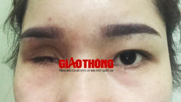 Bắc Giang: Nâng mũi tại cơ sở làm đẹp, cô gái bị mù vĩnh viễn-3