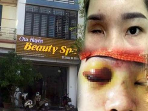 Tiêm filler nâng mũi trả góp, bé gái 13 tuổi mù mắt-4