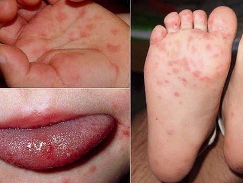 Những tháng cuối năm bệnh tay chân miệng ở trẻ gia tăng, cha mẹ đừng bỏ qua cảnh báo của chuyên gia
