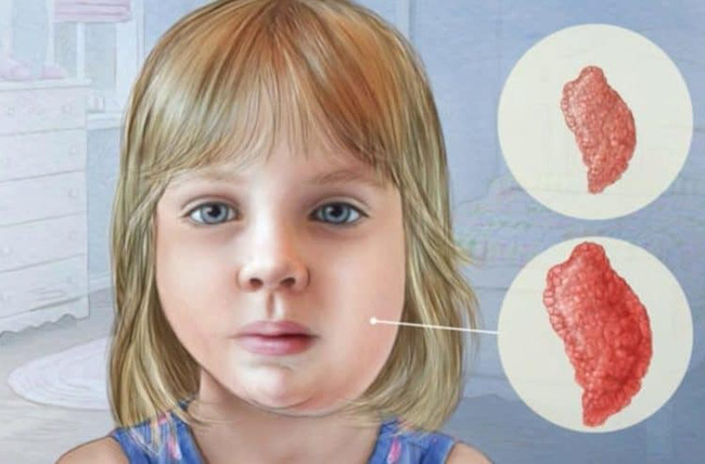 Bệnh quai bị có lây không không? Những con đường lây lan bệnh quai bị cha mẹ cần biết để phòng bệnh cho con-1