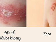 Phân biệt vết thương do kiến ba khoang với viêm da do zona để tránh dùng sai thuốc khiến bệnh càng khó chữa