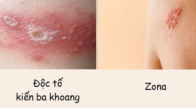 Phân biệt vết thương do kiến ba khoang với viêm da do zona để tránh dùng sai thuốc khiến bệnh càng khó chữa-1