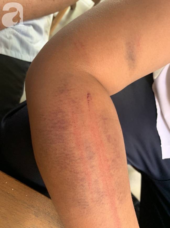 Nghi án bé trai bị bố ruột dùng dây điện bạo hành, đánh bầm tím khắp người vì viết chữ xấu-1