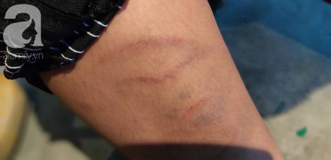 Nghi án bé trai bị bố ruột dùng dây điện bạo hành, đánh bầm tím khắp người vì viết chữ xấu-3