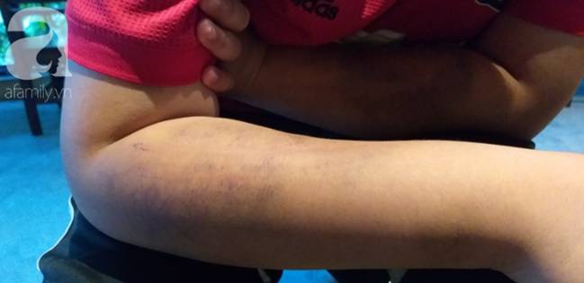 Nghi án bé trai bị bố ruột dùng dây điện bạo hành, đánh bầm tím khắp người vì viết chữ xấu-5
