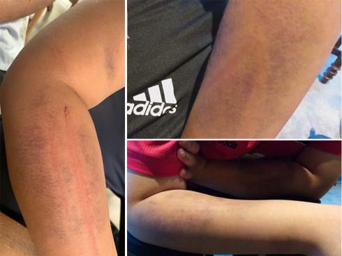 Lời kể đau đớn của bé trai nghi bị bố ruột dùng dây điện đánh bầm tím khắp người chỉ vì viết chữ xấu-9