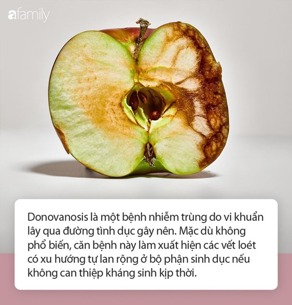 Những điều bạn cần biết về căn bệnh lây truyền qua đường tình dục có thể ăn thịt người này-1