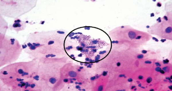 Những điều bạn cần biết về căn bệnh lây truyền qua đường tình dục có thể ăn thịt người này-2