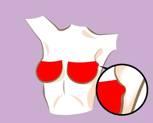 Nếu có 6 dấu hiệu này ở ngực, đừng coi nhẹ nên đi khám ngay trước khi muộn-4