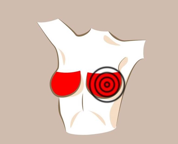 Nếu có 6 dấu hiệu này ở ngực, đừng coi nhẹ nên đi khám ngay trước khi muộn-5