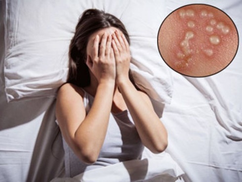 Hai mẹ con cùng bị mắc sùi mào gà, đồ vật này trong gia đình không nên dùng chung-3