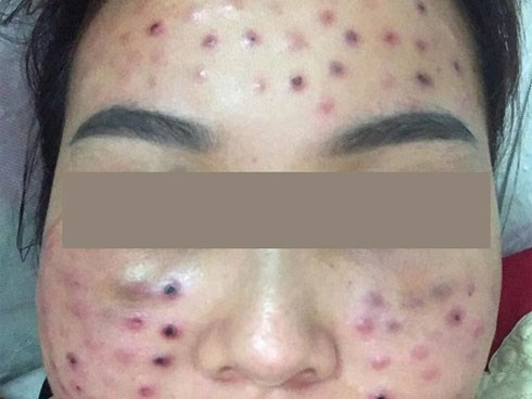 Tiêm căng bóng da tại một spa cỏ, cô gái nhận cái kết cay đắng với tình trạng mặt thâm rỗ như tổ ong