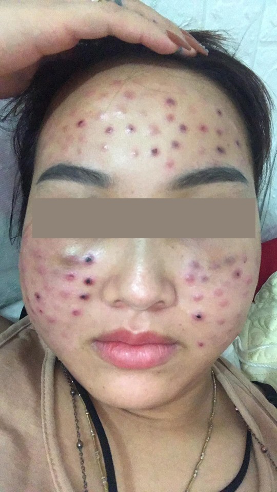 Tiêm căng bóng da tại một spa cỏ, cô gái nhận cái kết cay đắng với tình trạng mặt thâm rỗ như tổ ong-2