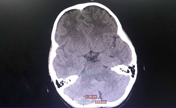 Cha mẹ chủ quan, bé gái suýt chết vì chấn thương sọ não sau té ngã-1